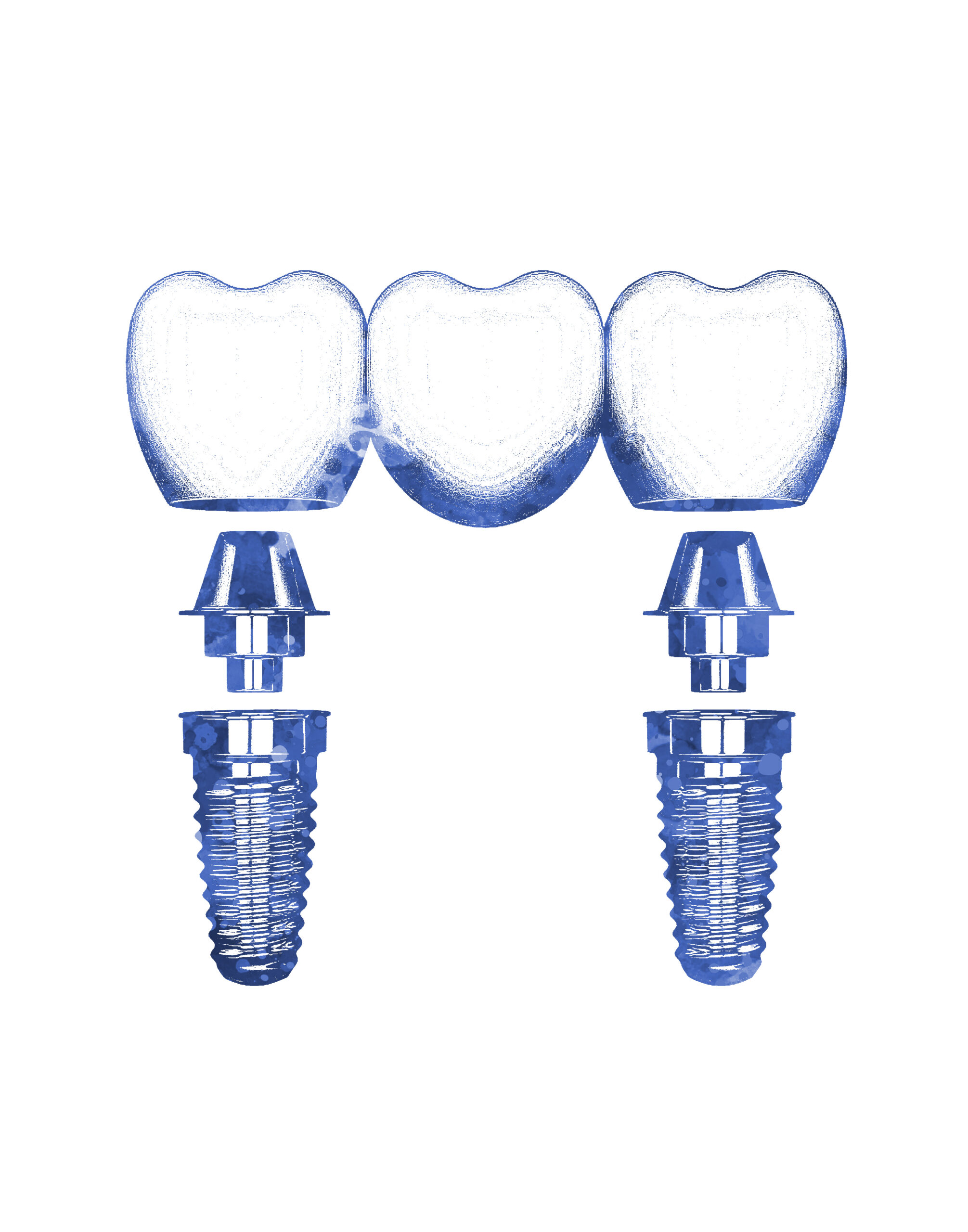 Eine Studie einer Zahnbrücke