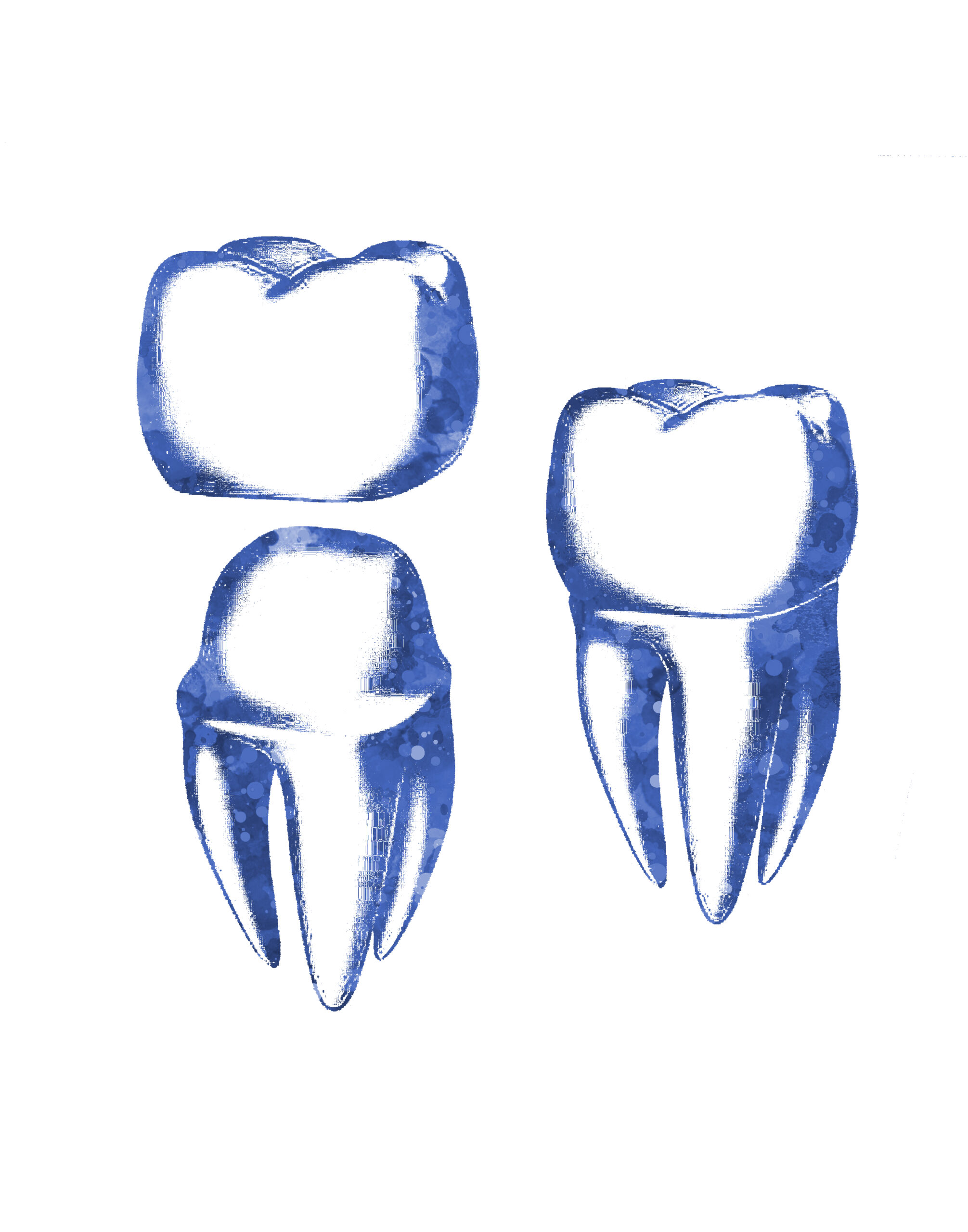Eine Studie einer aufgesetzten Zahnkrone