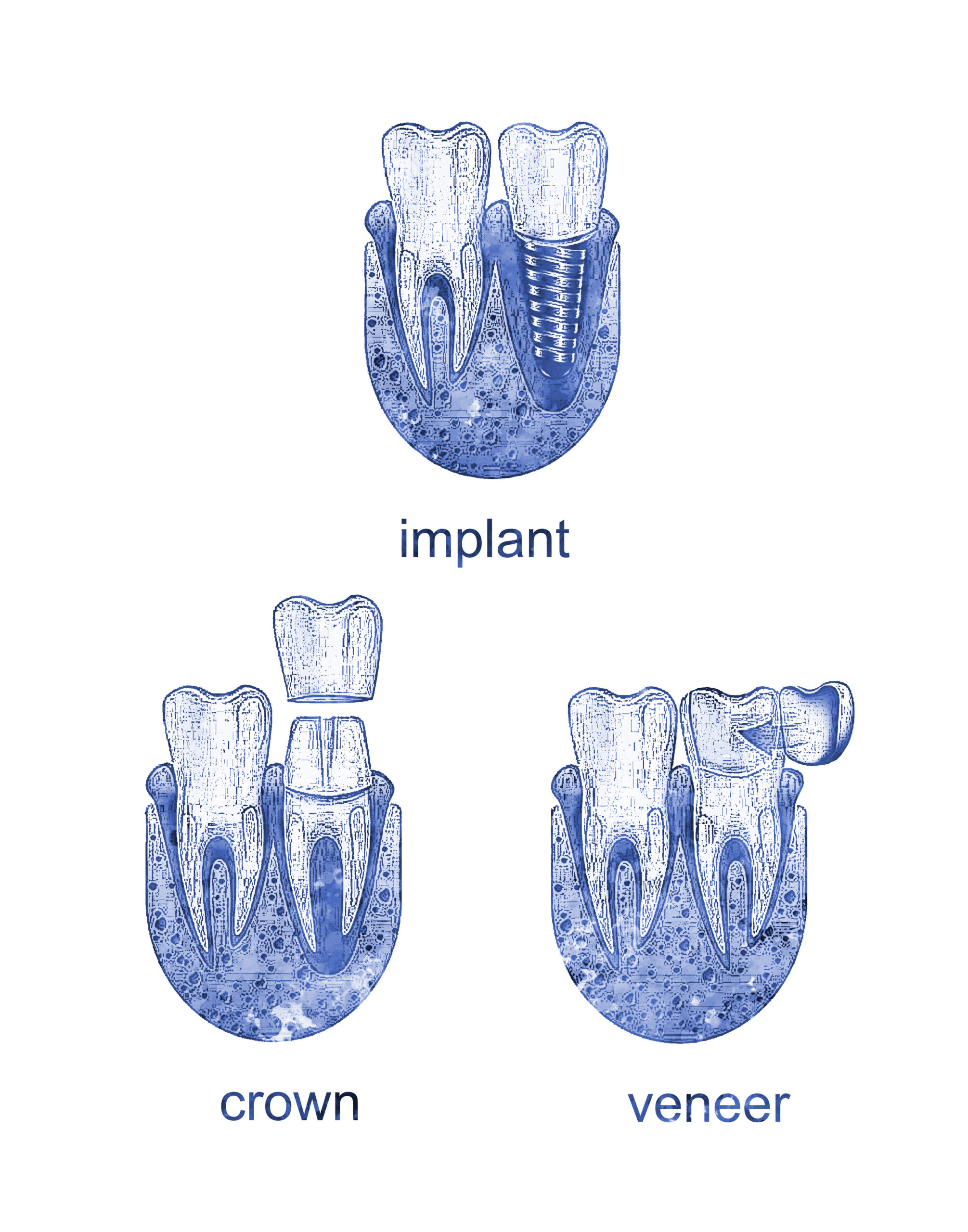 eine Übersicht über drei verschiedene Zahnersatze